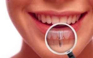 dental implants jenkintown