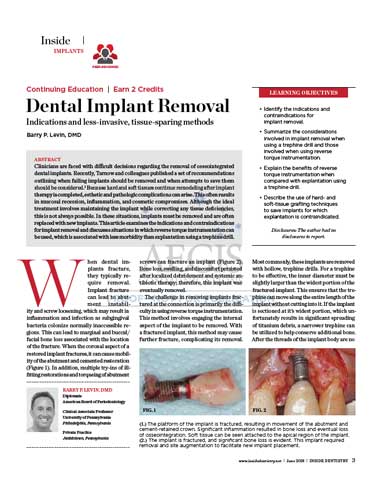 dental-implant-removal-article