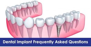 Dental Implant Frequently Asked Questions