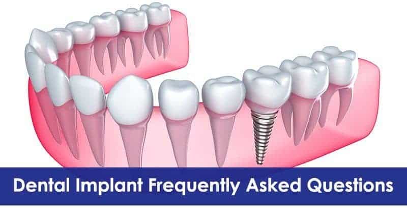 Dental Implant Frequently Asked Questions