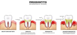 What Exactly is a Periodontist? 