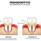 What Exactly is a Periodontist?