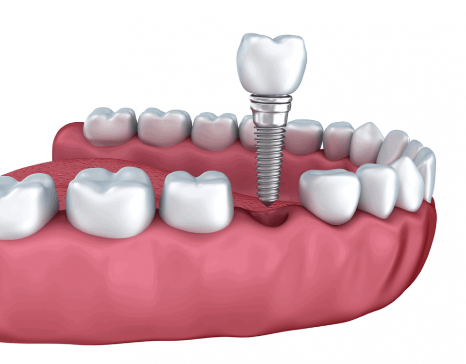 Why a Periodontist is Best for Dental Implants