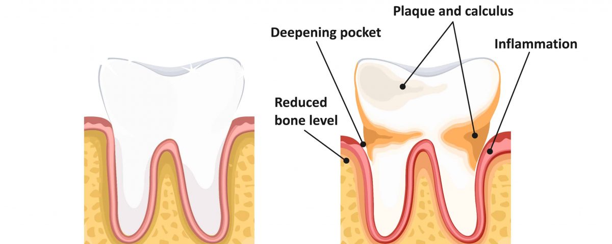 Treatments for Periodontal Disease to Save Your Teeth