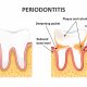 Treatments for Periodontal Disease to Save Your Teeth